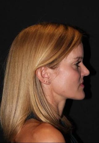 Rhinoplasty Before & After Gallery - Patient 129649 - Image 10