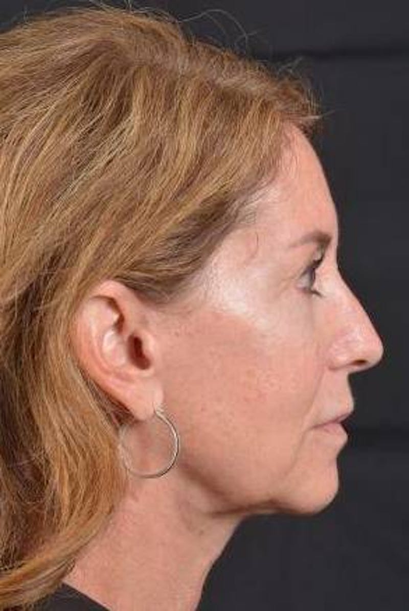 Facelift Before & After Gallery - Patient 353511 - Image 5