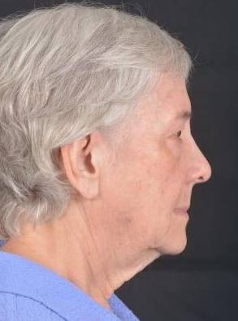 Blepharoplasty Before & After Gallery - Patient 425227 - Image 5