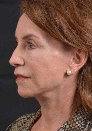 Facelift Before & After Gallery - Patient 353511 - Image 8