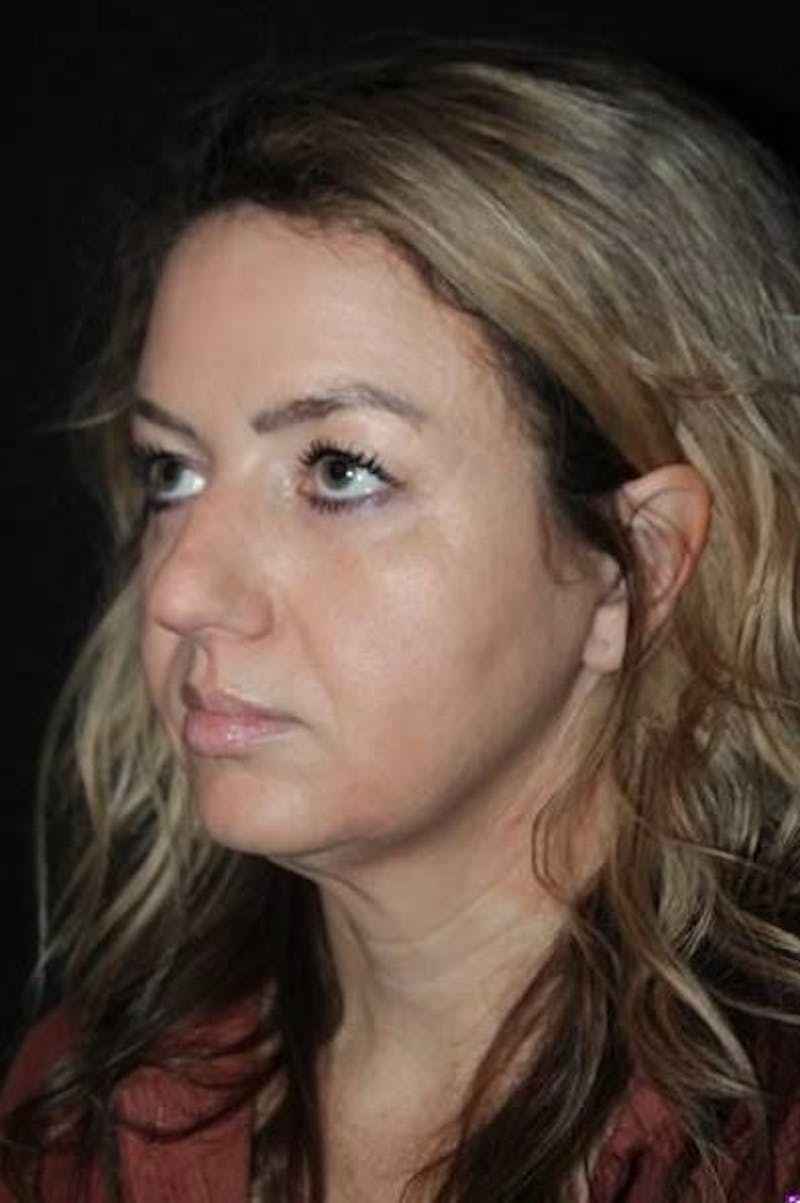 Rhinoplasty Before & After Gallery - Patient 428770 - Image 3