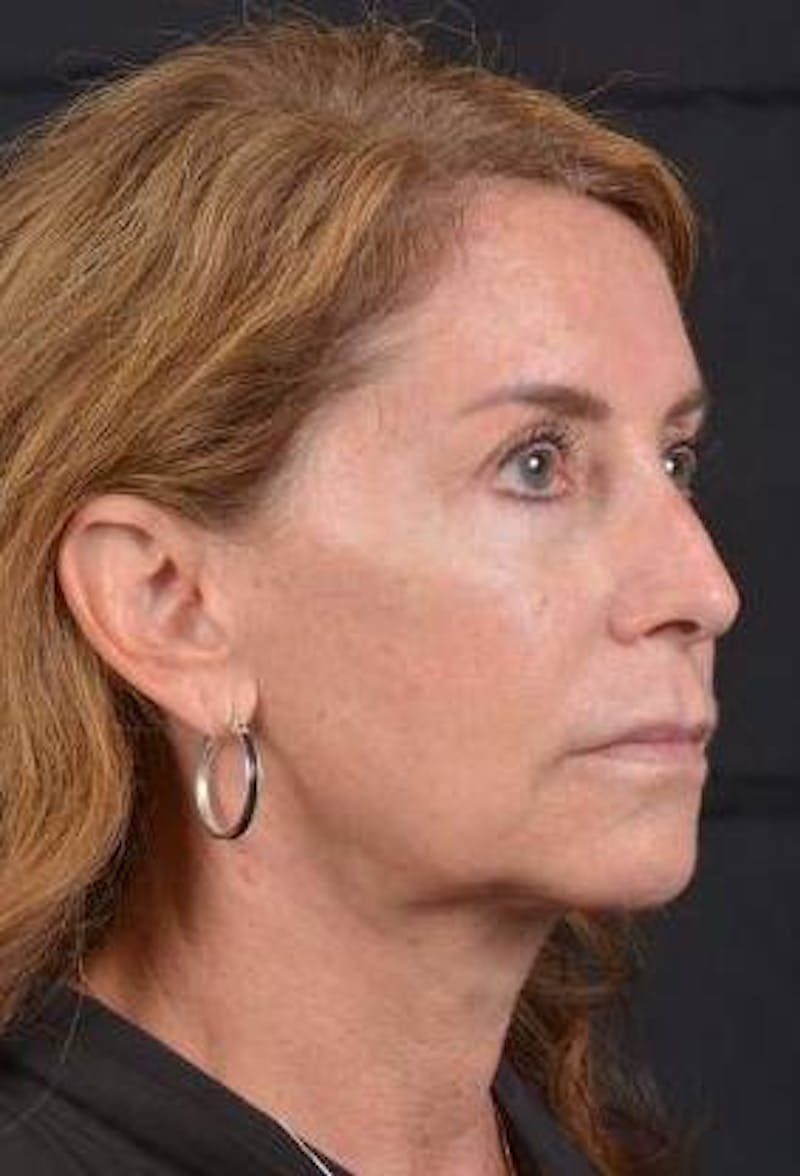 Facelift Before & After Gallery - Patient 353511 - Image 9