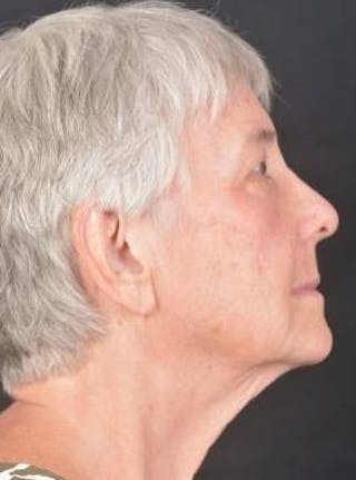 Blepharoplasty Before & After Gallery - Patient 425227 - Image 6