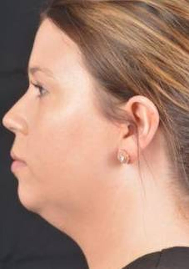 FaceTite Before & After Gallery - Patient 151843 - Image 3