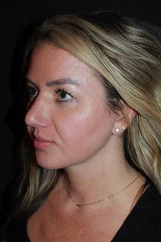 Rhinoplasty Before & After Gallery - Patient 428770 - Image 4
