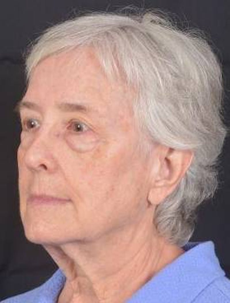 Blepharoplasty Before & After Gallery - Patient 425227 - Image 7