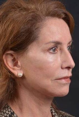 Facelift Before & After Gallery - Patient 353511 - Image 10