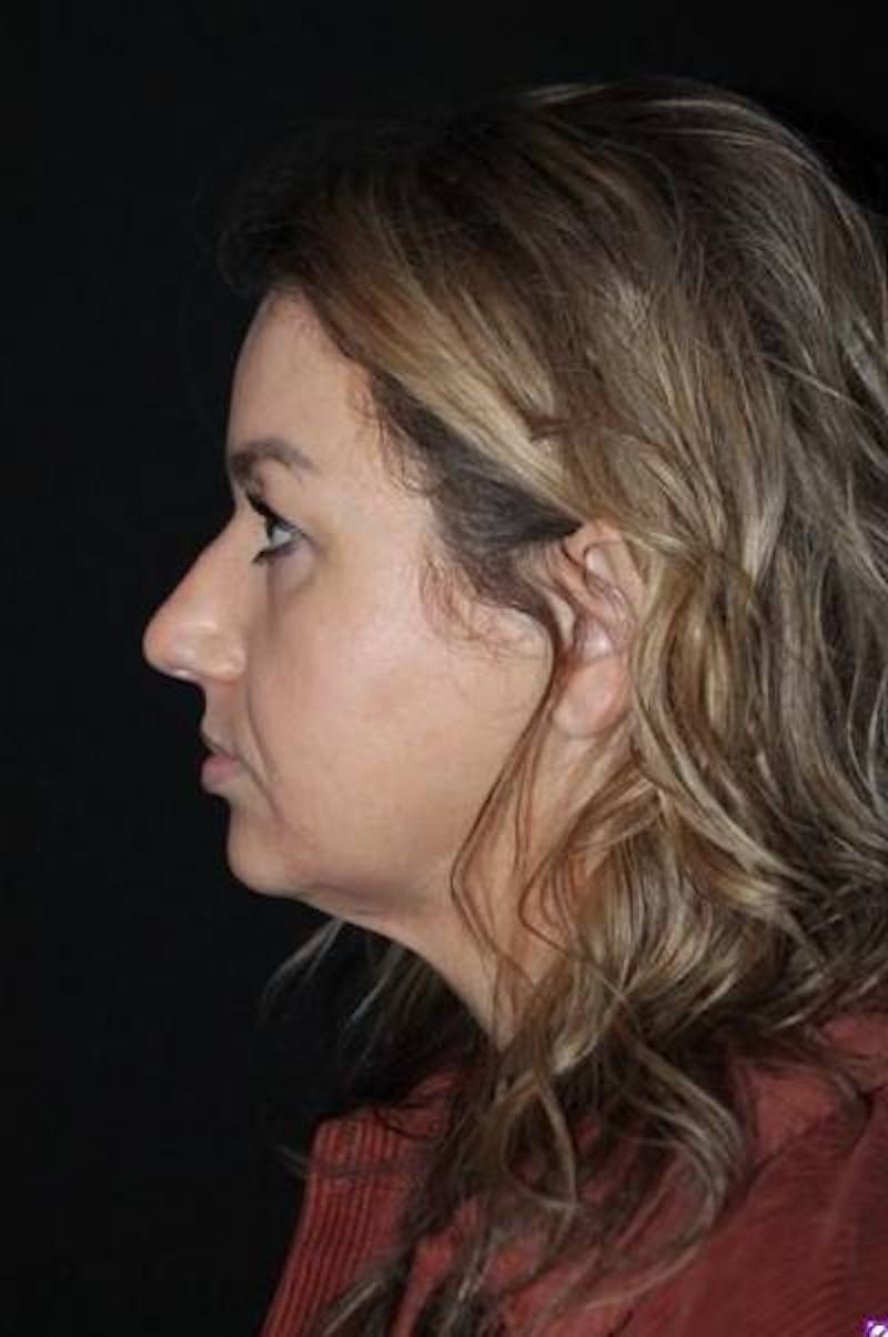 Rhinoplasty Before & After Gallery - Patient 428770 - Image 5