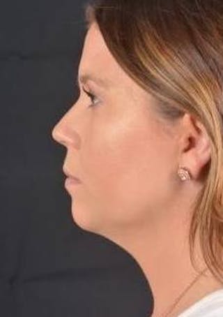 FaceTite Before & After Gallery - Patient 151843 - Image 4