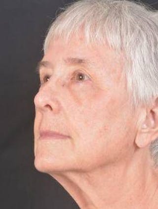 Blepharoplasty Before & After Gallery - Patient 425227 - Image 8