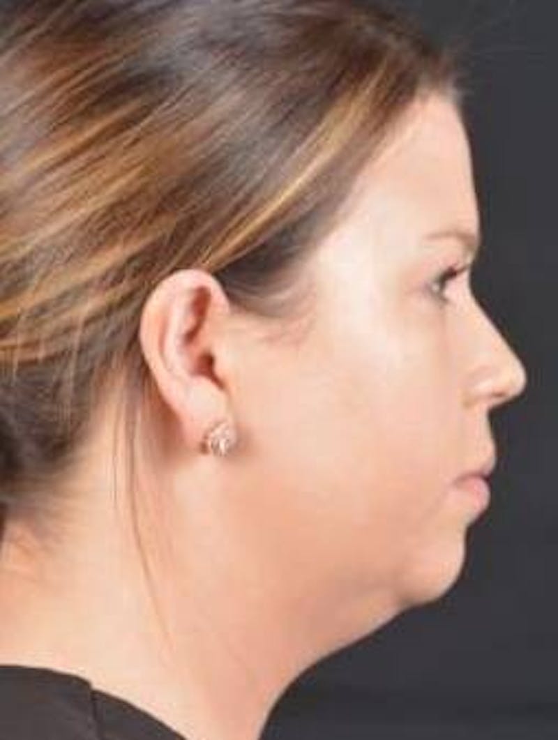 FaceTite Before & After Gallery - Patient 151843 - Image 5