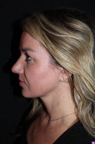 Rhinoplasty Before & After Gallery - Patient 428770 - Image 6