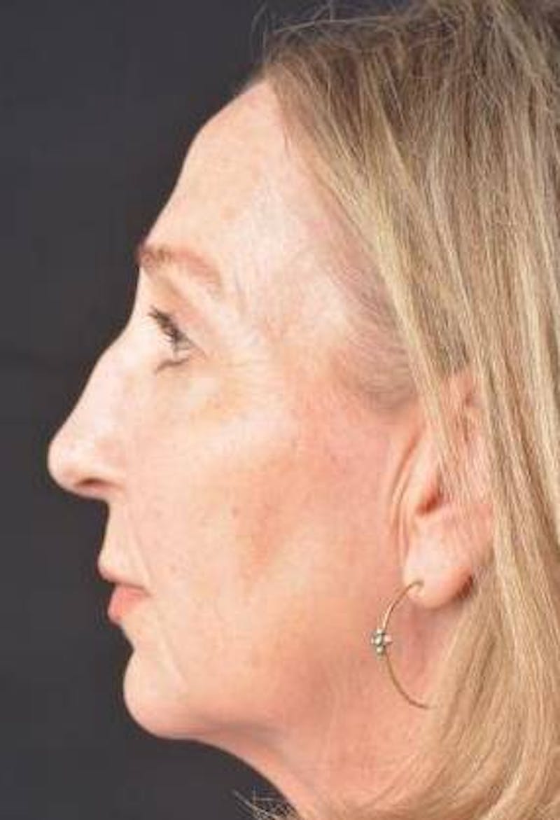 Facelift Before & After Gallery - Patient 338671 - Image 3