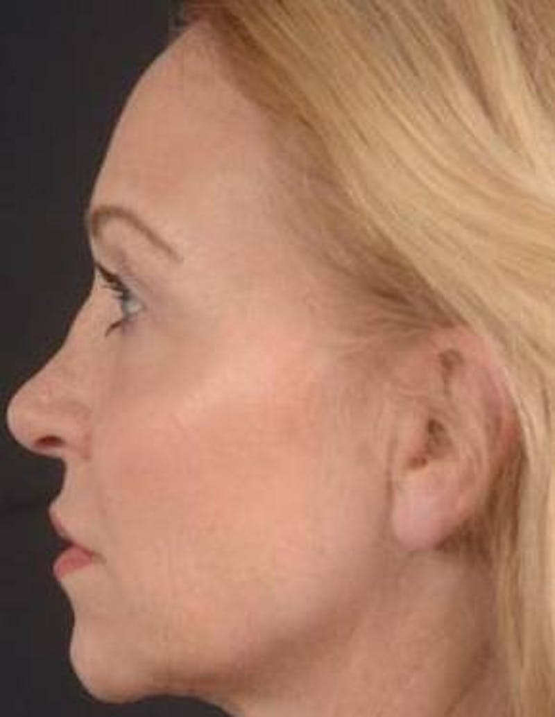 Blepharoplasty Before & After Gallery - Patient 563095 - Image 3