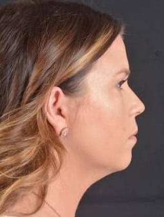 FaceTite Before & After Gallery - Patient 151843 - Image 6
