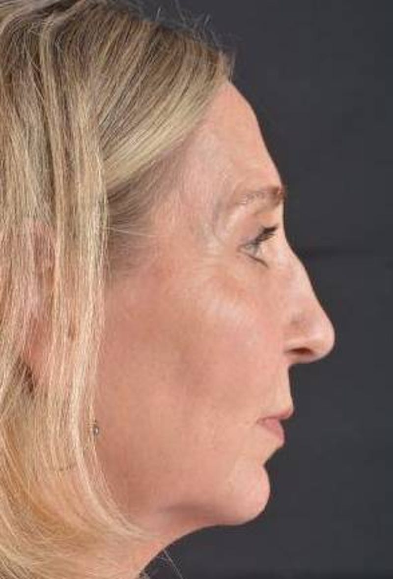 Facelift Before & After Gallery - Patient 338671 - Image 5