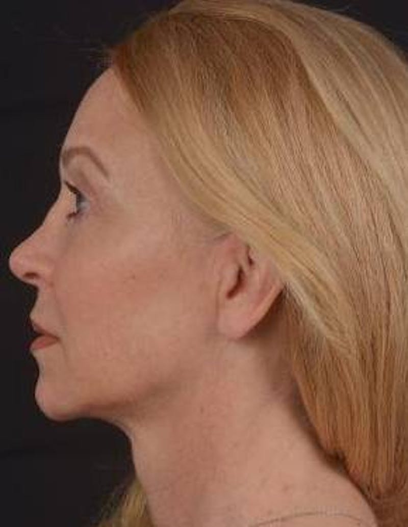 Blepharoplasty Before & After Gallery - Patient 563095 - Image 4