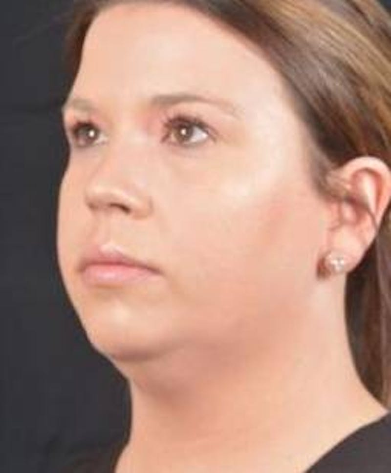 FaceTite Before & After Gallery - Patient 151843 - Image 7