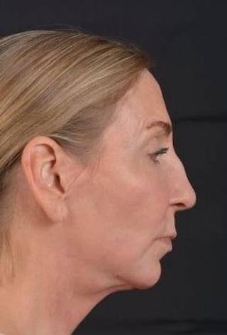 Facelift Before & After Gallery - Patient 338671 - Image 6