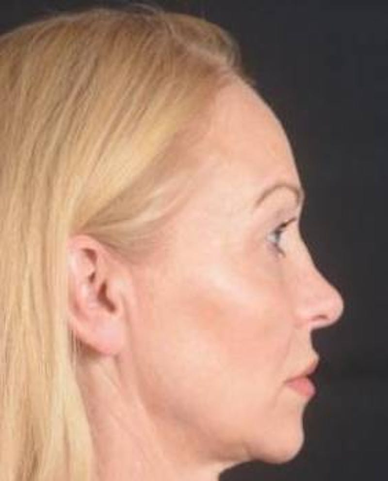 Blepharoplasty Before & After Gallery - Patient 563095 - Image 5
