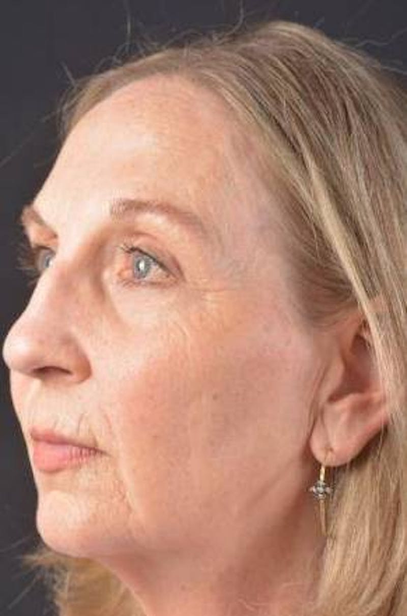 Facelift Before & After Gallery - Patient 338671 - Image 7
