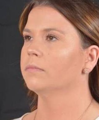 FaceTite Before & After Gallery - Patient 151843 - Image 8