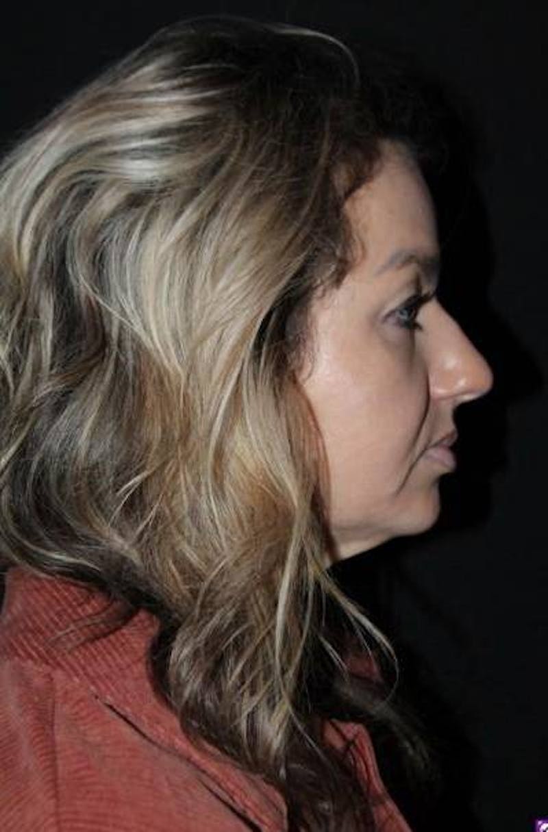 Rhinoplasty Before & After Gallery - Patient 428770 - Image 9