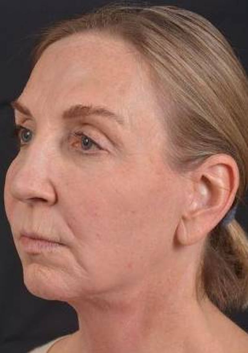Facelift Before & After Gallery - Patient 338671 - Image 8