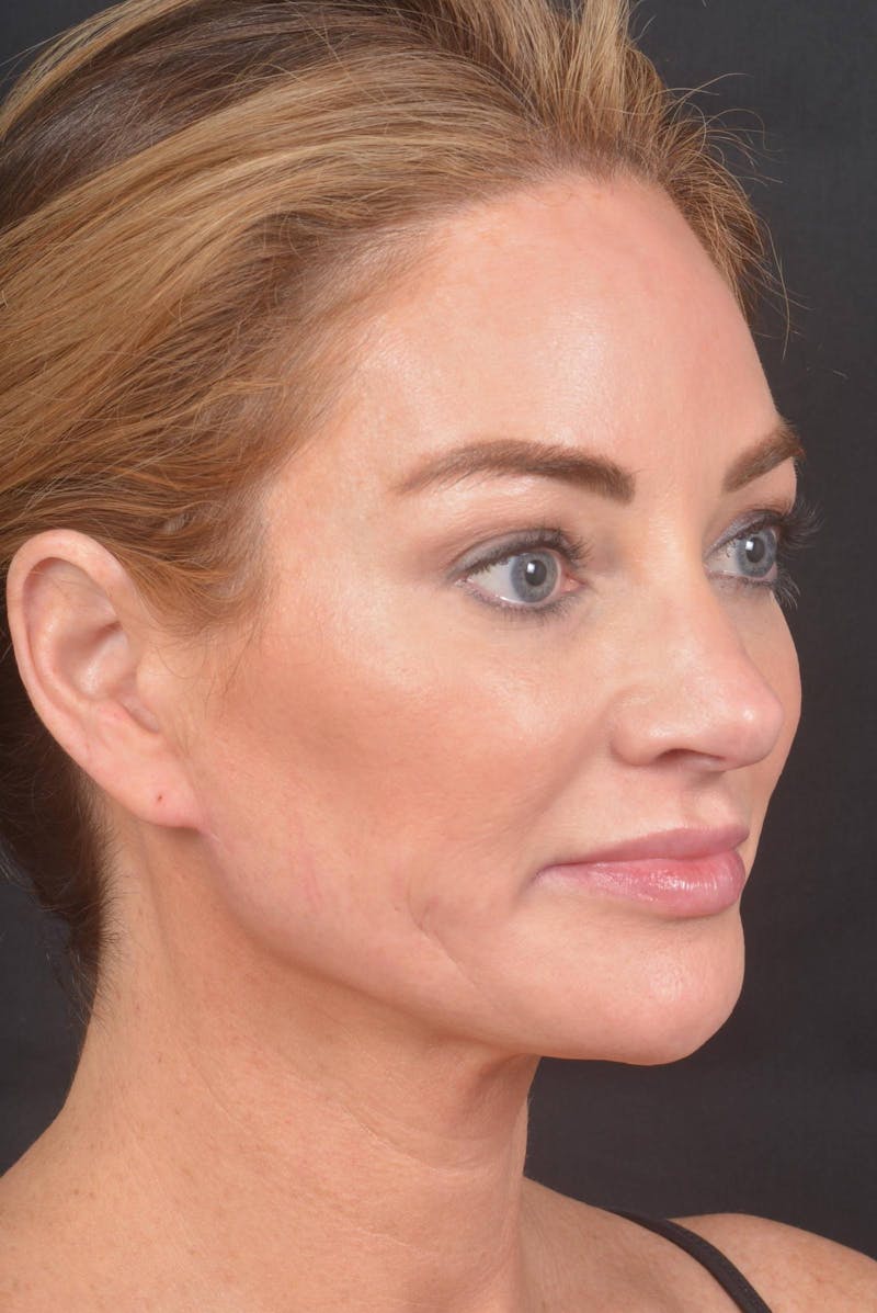 Necklift Before & After Gallery - Patient 158242 - Image 10