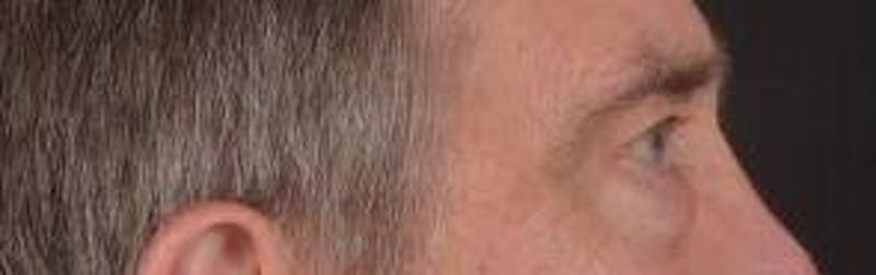 Blepharoplasty Before & After Gallery - Patient 208189 - Image 5