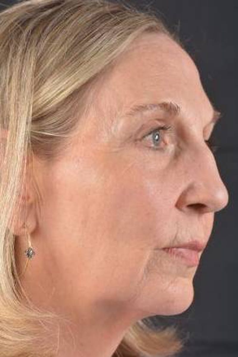 Facelift Before & After Gallery - Patient 338671 - Image 9