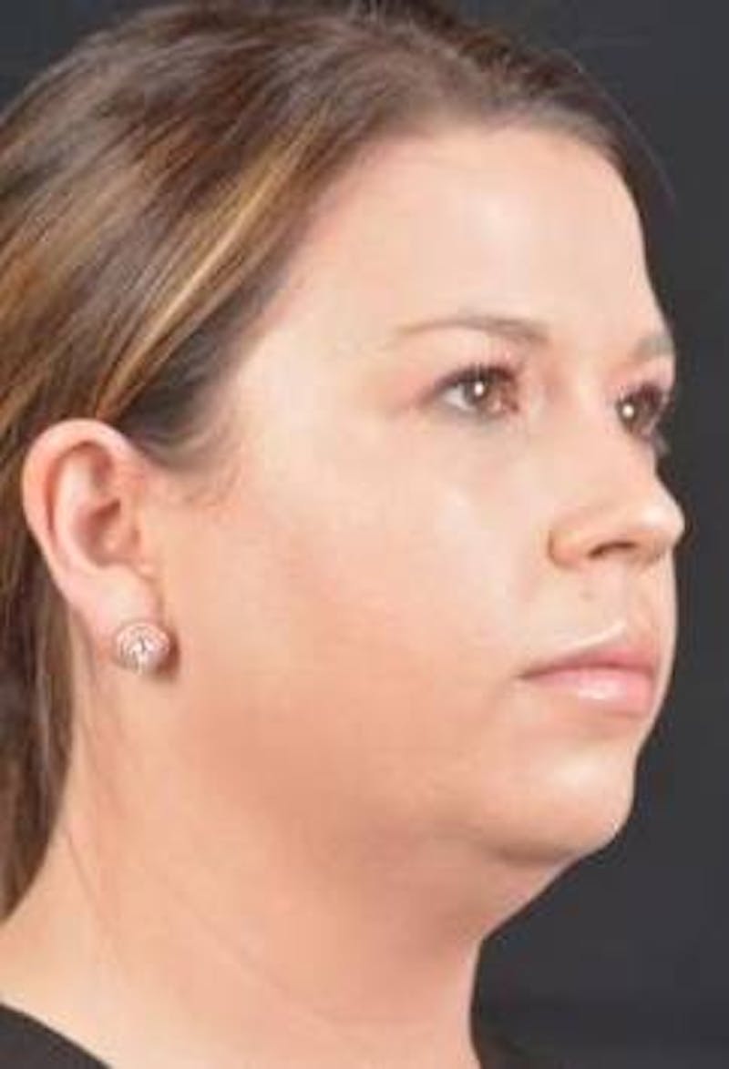 FaceTite Before & After Gallery - Patient 151843 - Image 9