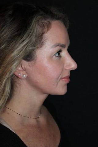 Rhinoplasty Before & After Gallery - Patient 428770 - Image 10