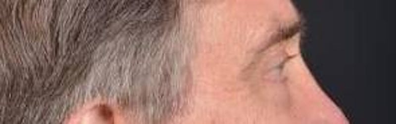 Blepharoplasty Before & After Gallery - Patient 208189 - Image 6