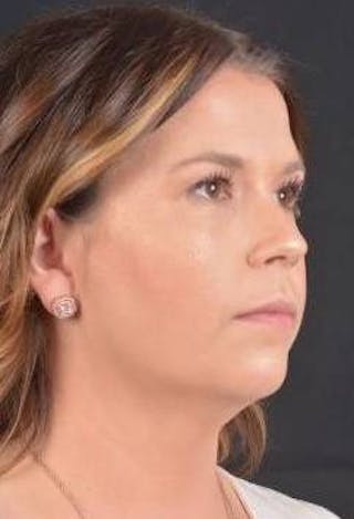 FaceTite Before & After Gallery - Patient 151843 - Image 10