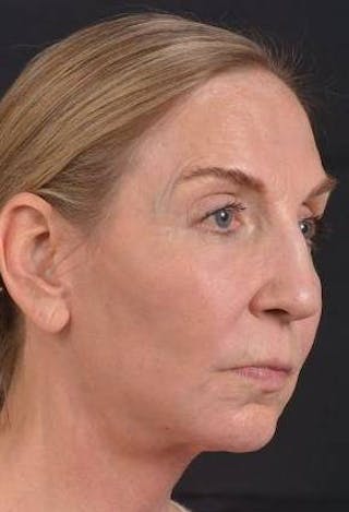 Facelift Before & After Gallery - Patient 338671 - Image 10