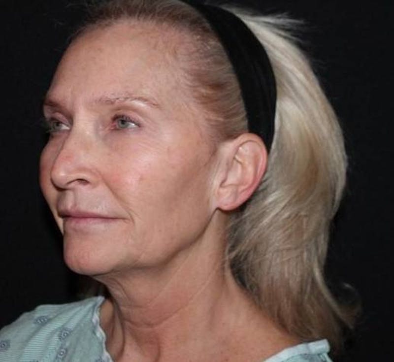 Necklift Before & After Gallery - Patient 103185 - Image 3