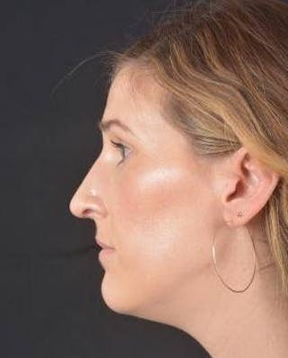 Rhinoplasty Before & After Gallery - Patient 251544 - Image 4