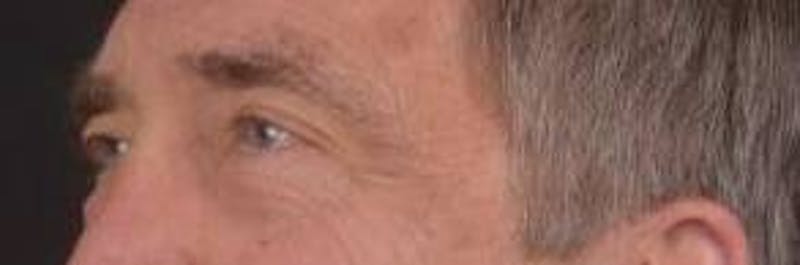 Blepharoplasty Before & After Gallery - Patient 208189 - Image 7