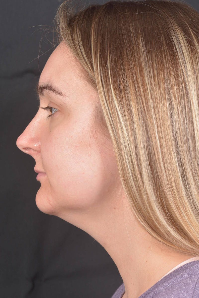 FaceTite Before & After Gallery - Patient 825707 - Image 3