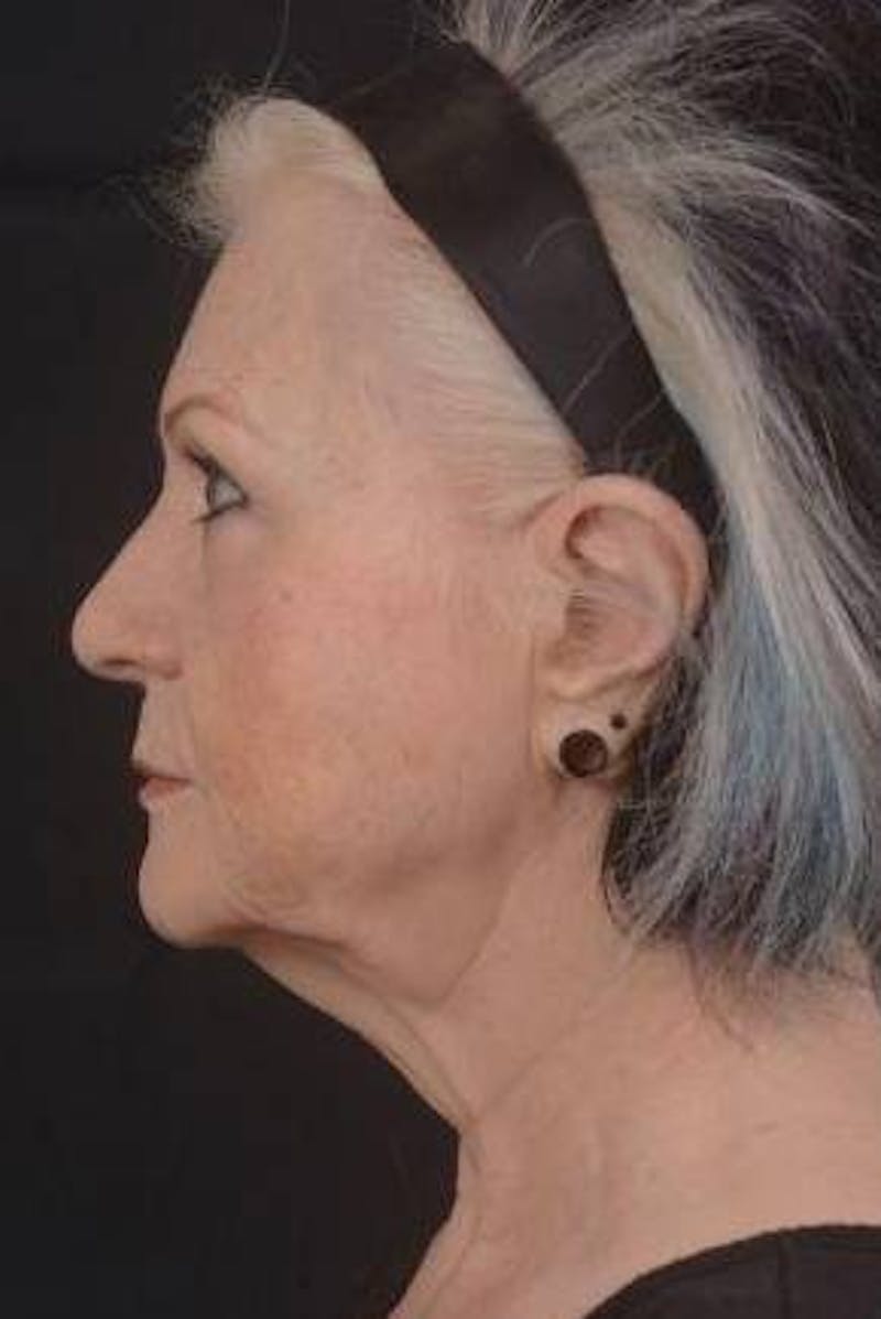 Facelift Before & After Gallery - Patient 385952 - Image 3