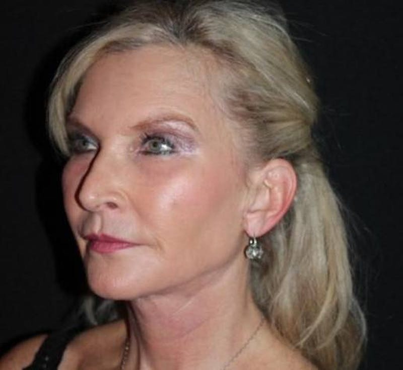 Necklift Before & After Gallery - Patient 103185 - Image 4