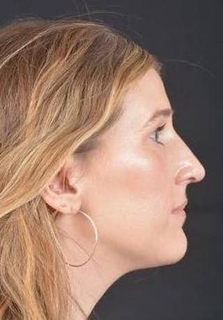 Rhinoplasty Before & After Gallery - Patient 251544 - Image 6