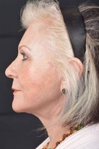 Facelift Before & After Gallery - Patient 385952 - Image 4