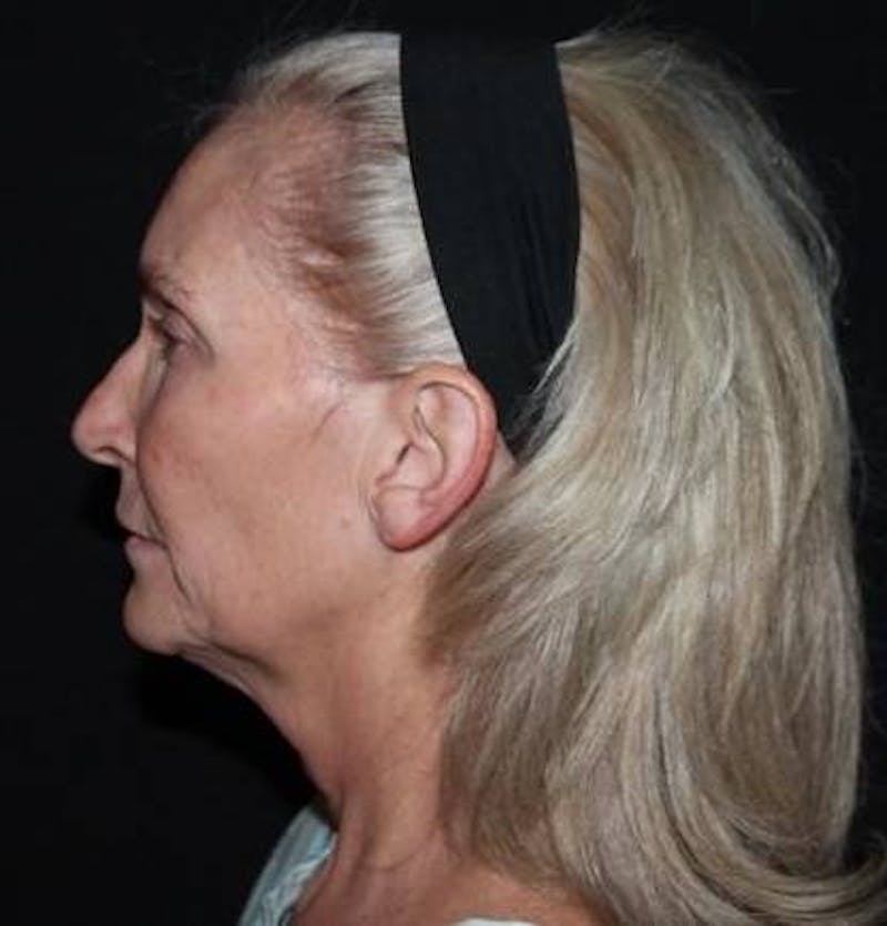 Necklift Before & After Gallery - Patient 103185 - Image 5