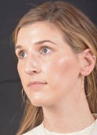 Rhinoplasty Before & After Gallery - Patient 251544 - Image 8