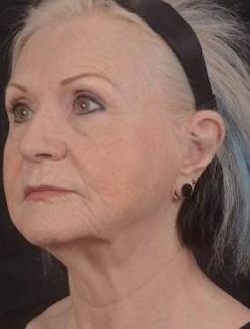 Facelift Before & After Gallery - Patient 385952 - Image 7