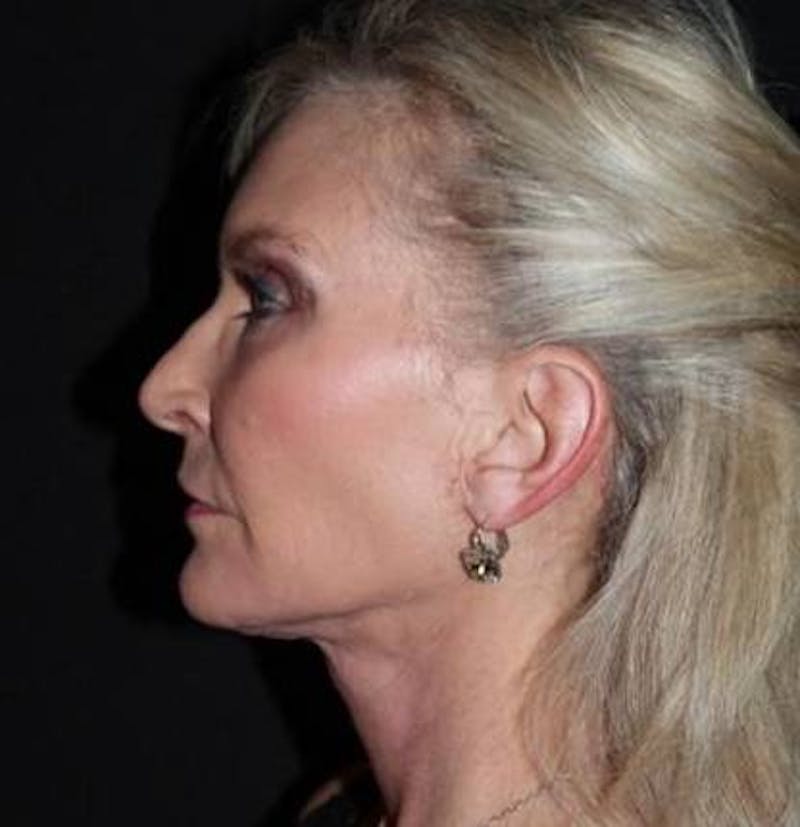 Necklift Before & After Gallery - Patient 103185 - Image 6