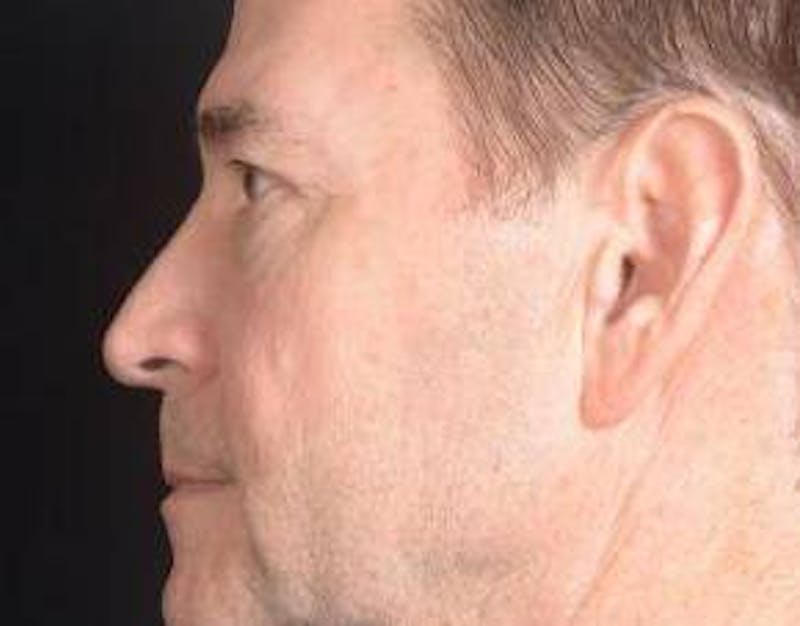 Blepharoplasty Before & After Gallery - Patient 254252 - Image 3