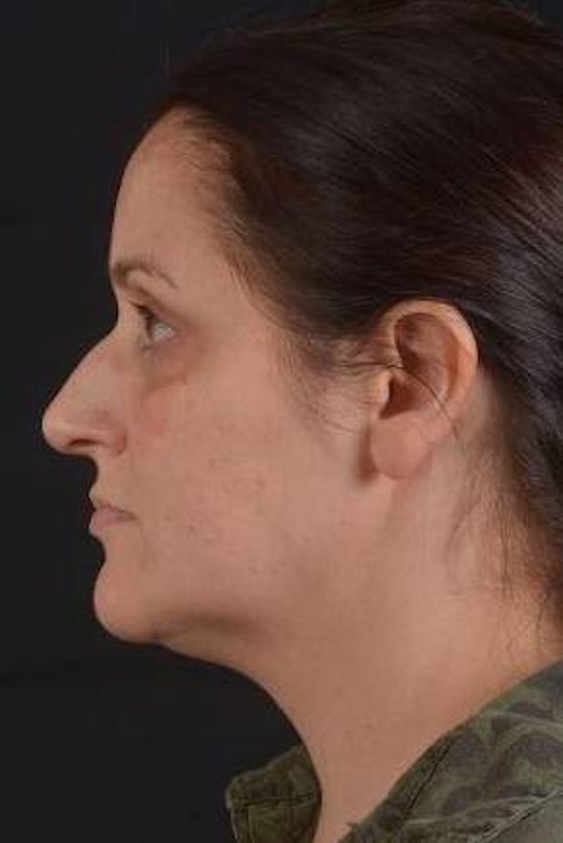 FaceTite Before & After Gallery - Patient 184387 - Image 3